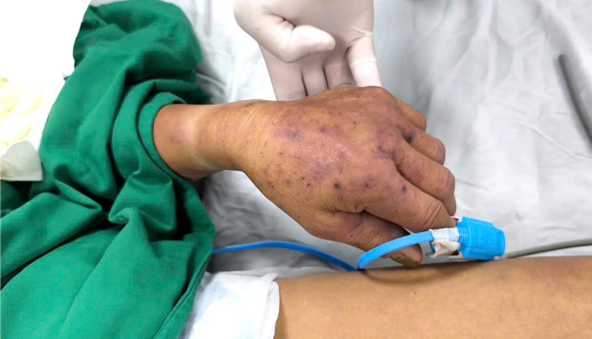 Ban huyết xuất hiện dưới da 