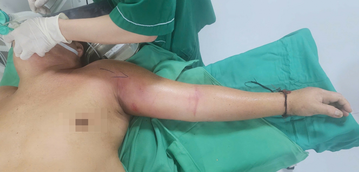 Bệnh nhân nhập viện trong tình trạng đau sưng toàn bộ tay trái do tự tiêm mật gấu để chữa đau ngực