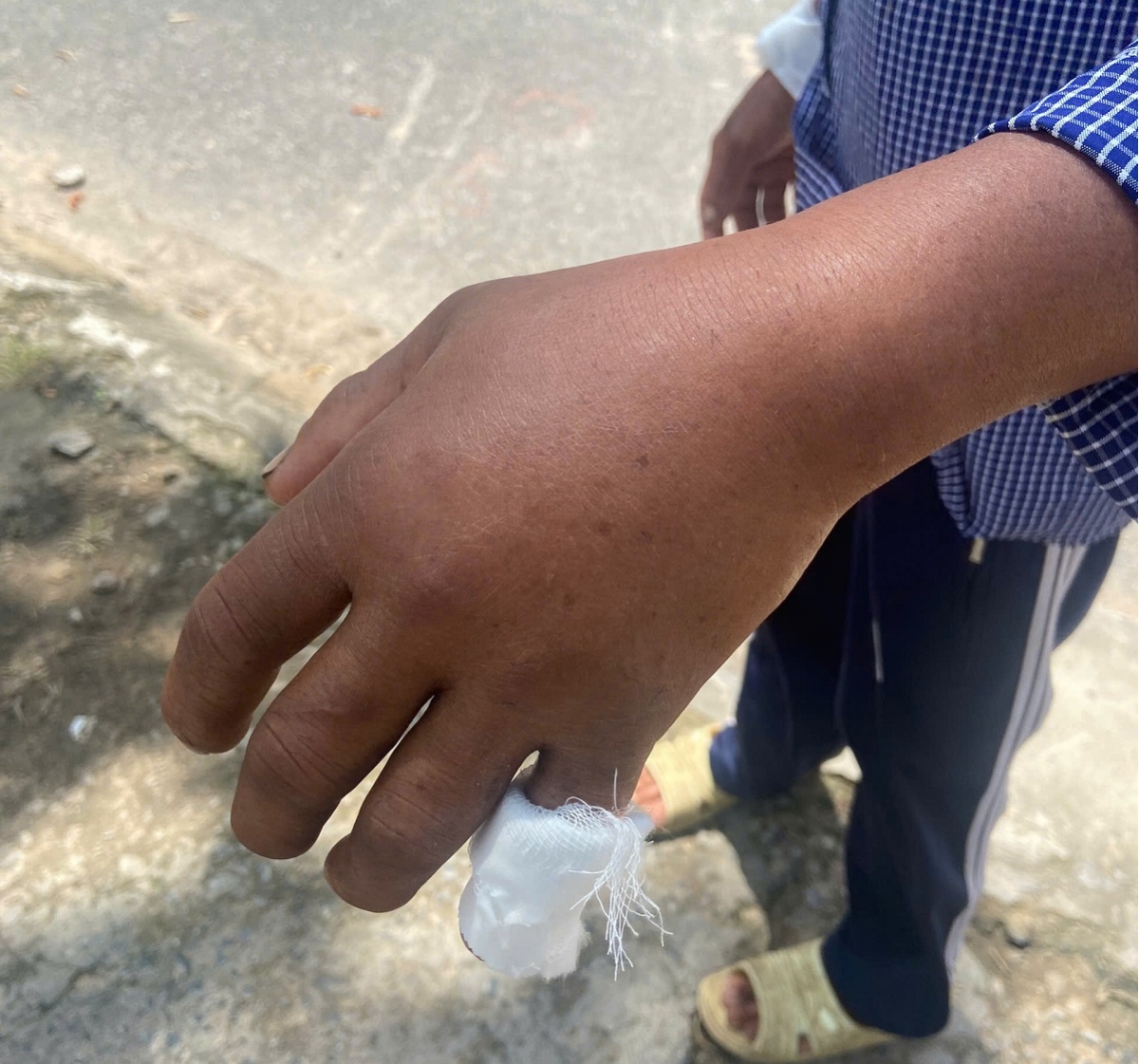 Bàn tay trái của nạn nhân bị sưng tấy do rắn cắn - Ảnh: B.H