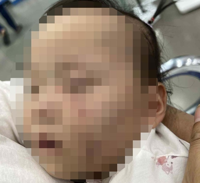 Hình ảnh bé gái ở Bắc Ninh với vết bầm trên mặt. Ảnh: Người dân cung cấp