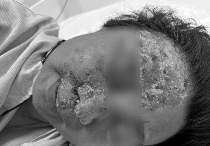 Zona gây ảnh hưởng nghiêm trọng đến chất lượng sống người bệnh