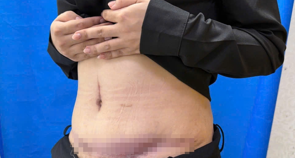 Vùng bụng bị tổn thương đã được xử lý sau hút mỡ, tiêm trị sẹo (ảnh BVCC)