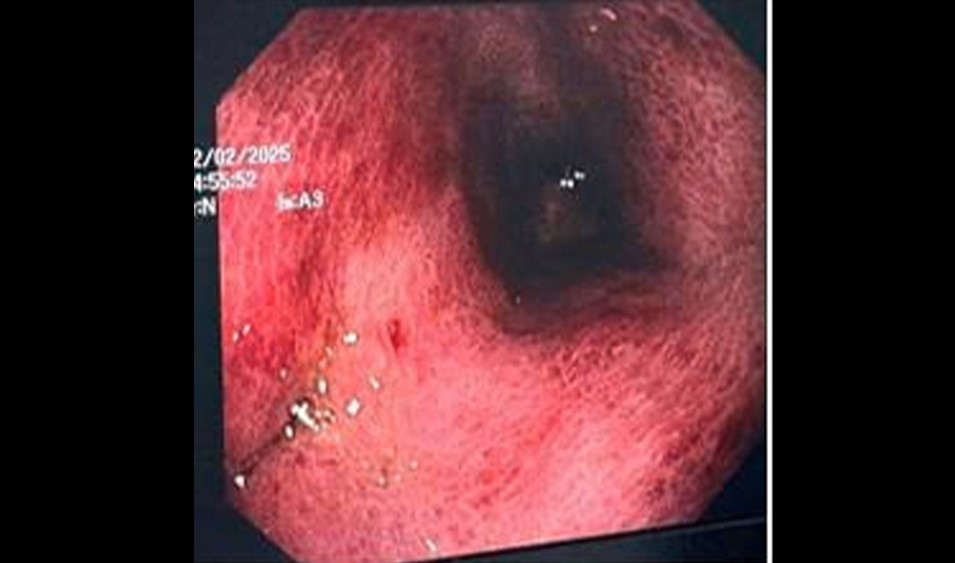 Hình ảnh niêm mạc dạ dày thực quản xung huyết, mủn nát và có lỗ thoát mủ