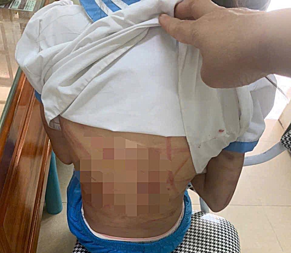 Cháu H.T.N.L. chi chít vết thương sau khi bị đánh.