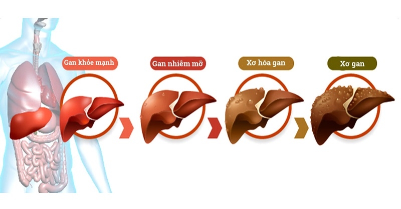 Biến chứng của bệnh gan nhiễm mỡ. Ảnh: KT