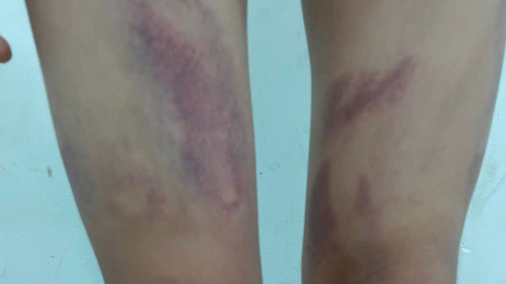 M.T bị đánh đa chấn thương 