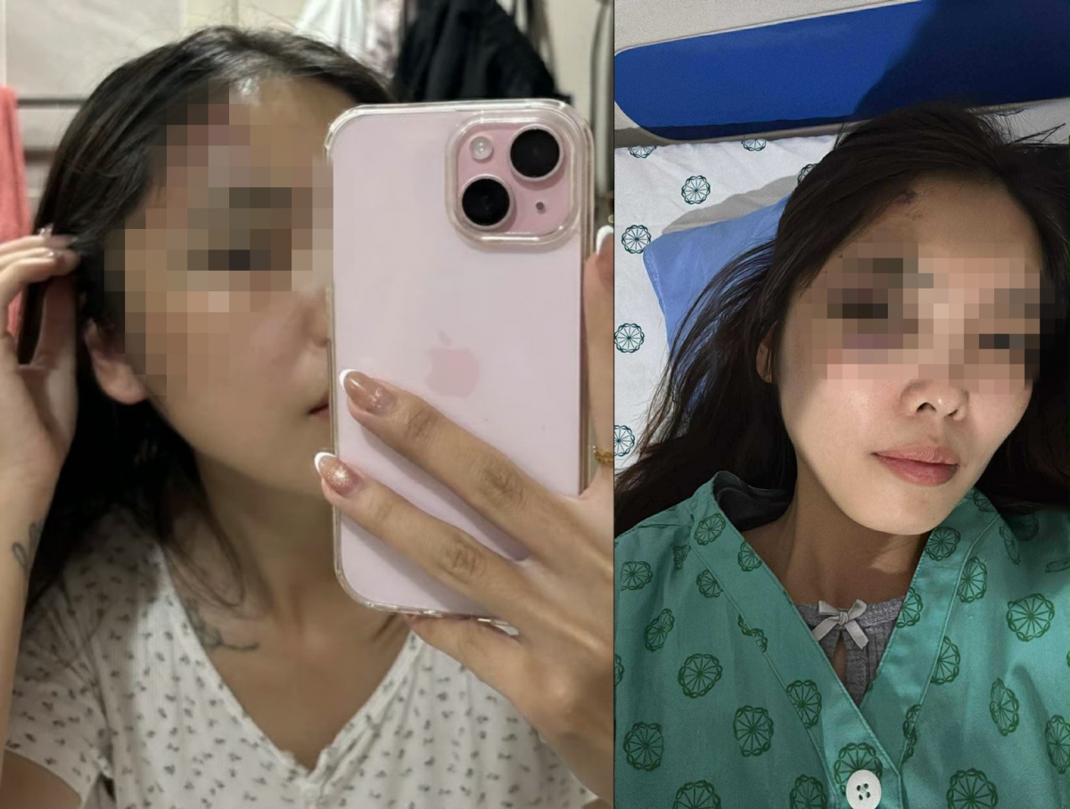 Hình ảnh chị T. sau khi bị hành hung phải nhập viện