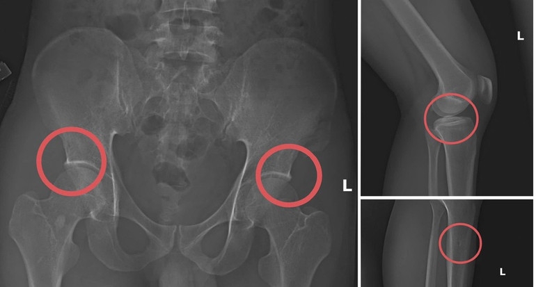 Bản phim chụp XQ một số tổn thương xương do đối tượng tạo ra nhằm trục lợi tiền bảo hiểm nhân thọ.