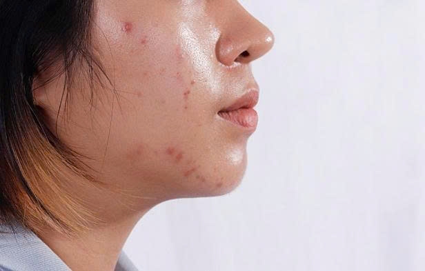 Để kiểm soát dầu nhờn hiệu quả, cần kết hợp các biện pháp làm sạch tức thời với chăm sóc da lâu dài