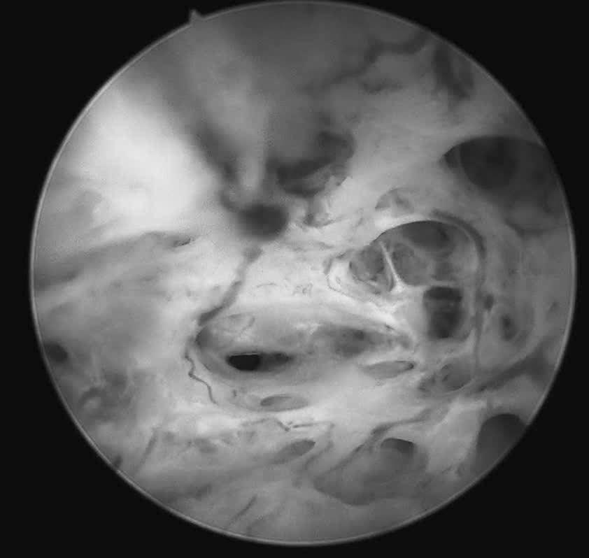 Hình ảnh niêm mạc nham nhở, tăng sinh không đồng đều, nhiều mạch máu bất thường của bệnh nhân. (Ảnh: BVCC)