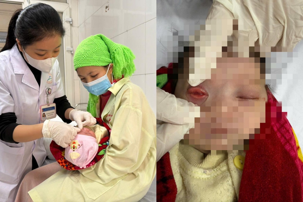 Bệnh nhi 1 tháng tuổi phải nhập viện trong tình trạng hai mắt sưng nề, chảy nhiều mủ. (Ảnh: BVCC)