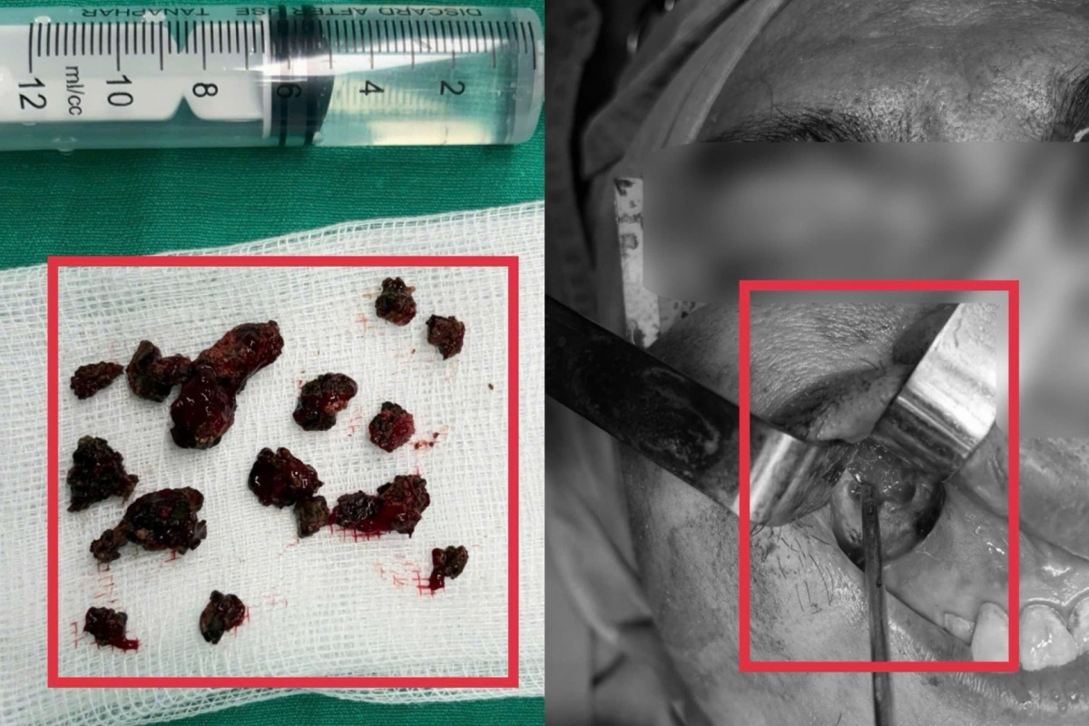 Nhiều ổ nấm đen đặc trong xoang hàm, lan rộng trên niêm mạc xoang người bệnh. (Ảnh: BVCC).