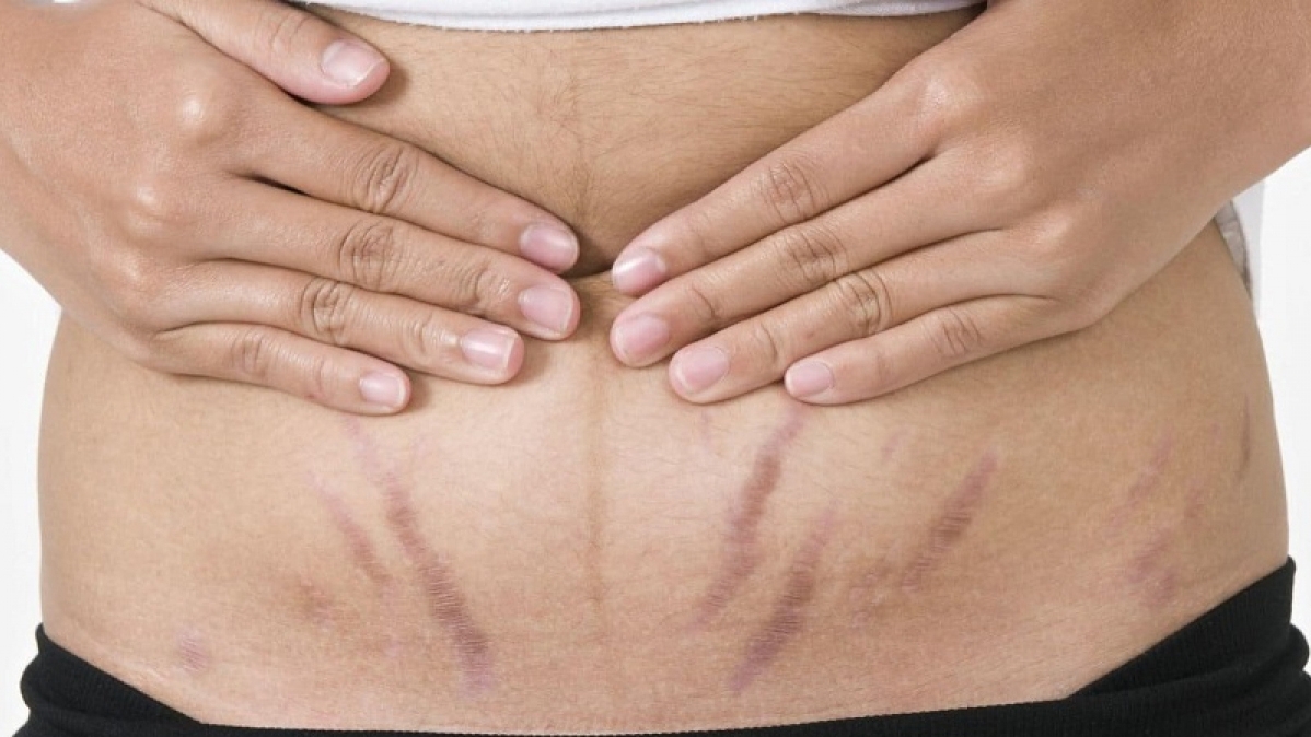 Rạn da sau sinh luôn là vấn đề “đau đầu” của chị em. (Ảnh Internet)