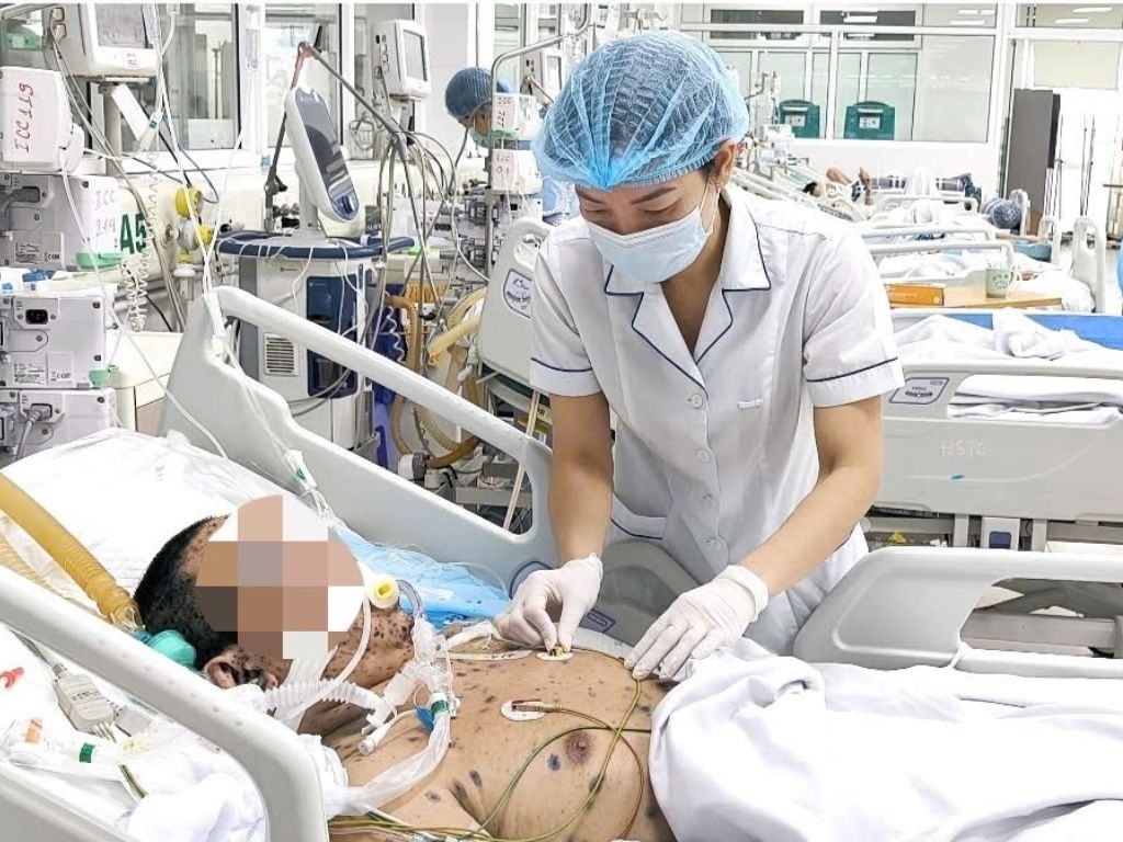 Người đàn ông 36 tuổi bị lây thủy đậu từ con gái dẫn đến biến chứng viêm phổi ARDS, sốc nhiễm khuẩn nghiêm trọng, phải can thiệp hồi sức tích cực và thở oxy. (Ảnh: BVCC)