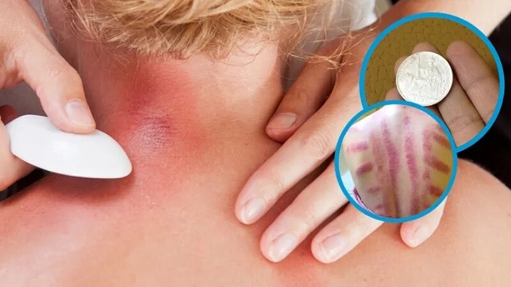 Nhiều người đau mỏi người, 'trúng gió' dùng đồ bạc, trứng gà cạo gió (Ảnh minh họa)