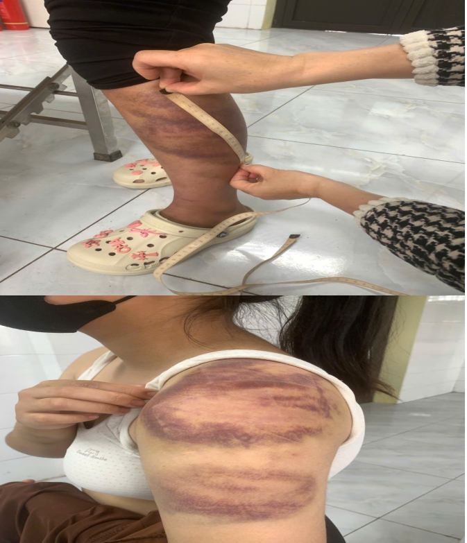 Vết bầm tím trên cơ thể cháu T. do bị bố đẻ đánh.