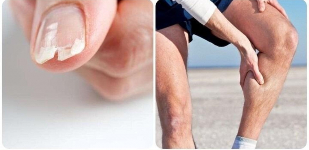 Dấu hiệu cảnh báo cơ thể đang thiếu canxi hay bị nhiều người bỏ qua. (Ảnh minh họa: VTC News)