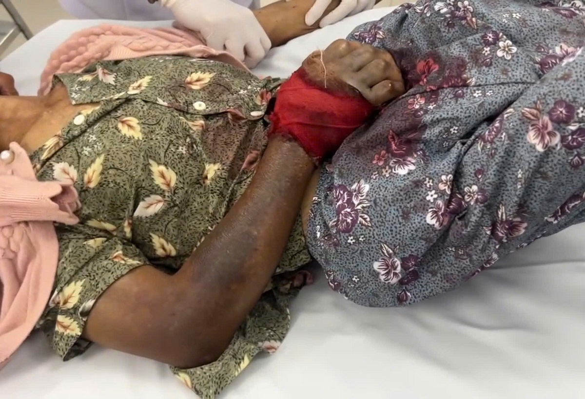 Cánh tay sưng to, tím đen. Ảnh: B.H