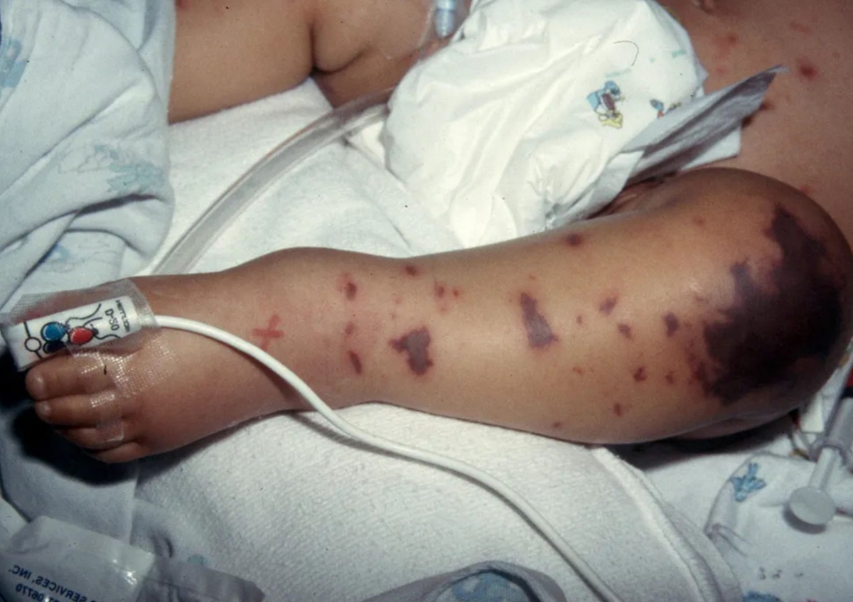 Dấu hiệu tử ban điển hình trên da của trẻ mắc viêm màng não mô cầu. (Nguồn: Meningitis Now)