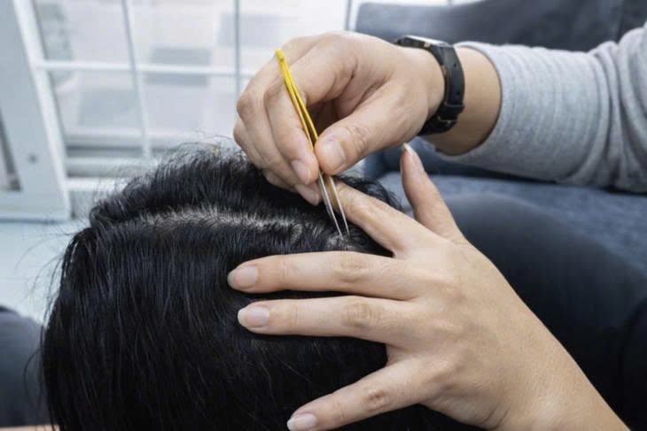 Chuyên gia cảnh báo nhổ tóc nhiều lần có thể khiến tóc không mọc lại - Ảnh: AI