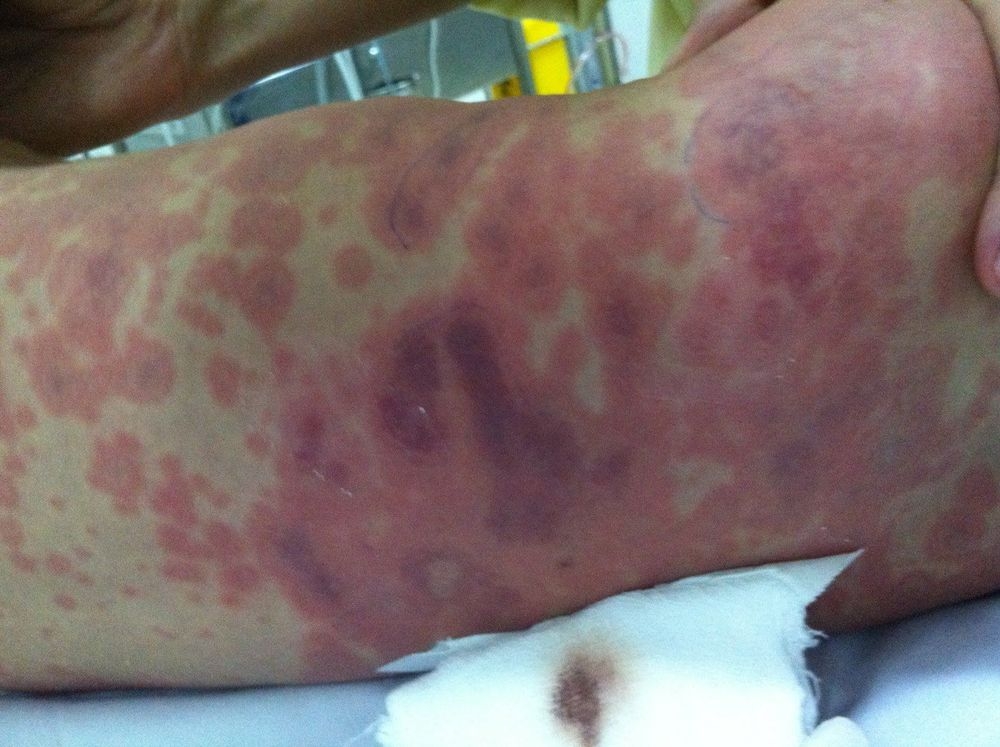 Dấu hiệu bệnh viêm màng não mô cầu