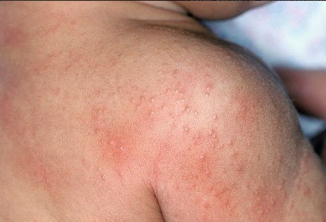 Trẻ bị rôm sảy. Ảnh: ksbtdanang.vn