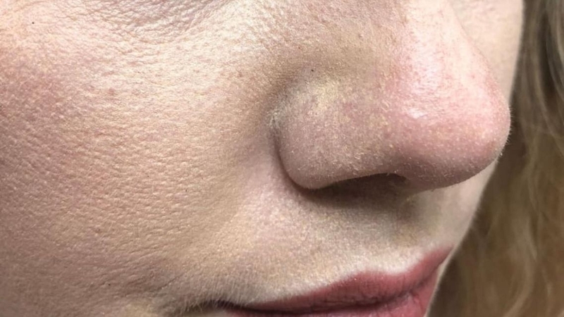 Để hạn chế kem chống nắng bị vón cục, nên cấp ẩm nhẹ trước khi thoa, đồng thời chờ các bước skincare thẩm thấu hoàn toàn để tránh xung đột giữa các lớp sản phẩm