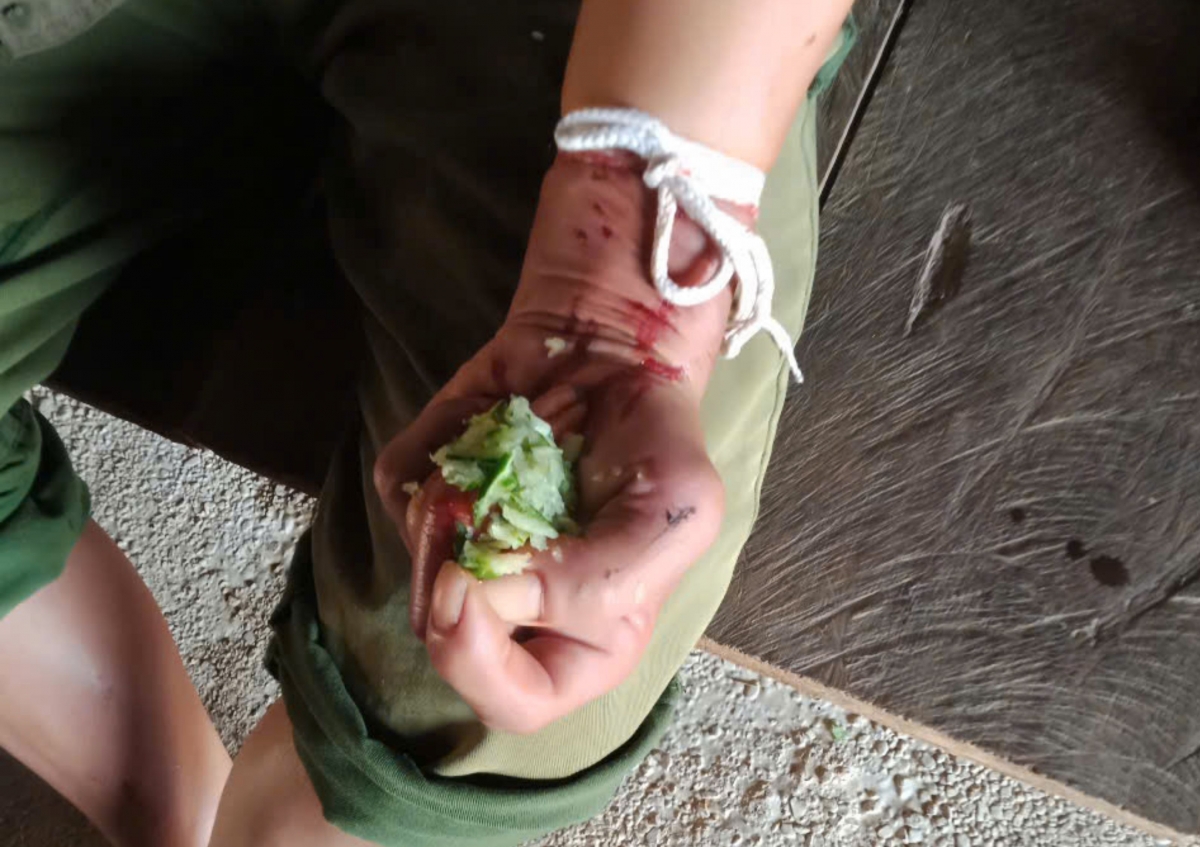 Hình ảnh vết rắn cắn ở tay người bệnh. (Ảnh BVCC).