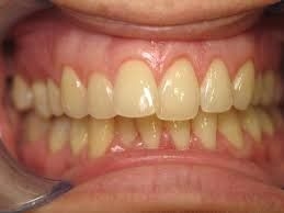 Răng cửa bị đổi màu không chỉ ảnh hưởng thẩm mỹ mà còn khiến nhiều người mất tự tin khi giao tiếp