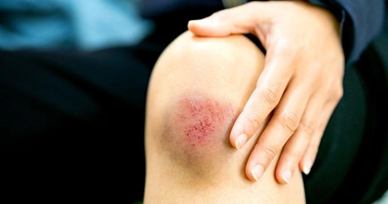 Khi da bị trầy xước, ngoài thực phẩm nên bổ sung, bạn cũng cần hạn chế những món có thể khiến vết thương lâu lành hoặc dễ để lại sẹo