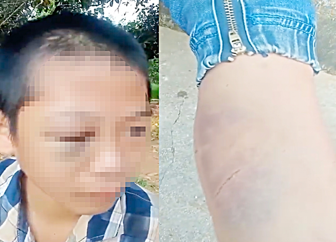 Cháu Th. bị bầm tím vùng mắt và chân nghi bị bạo hành. (Ảnh cắt từ clip).