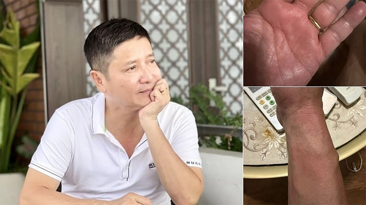 NSƯT Chí Trung chia sẻ anh mắc bệnh lạ, mất ngủ triền miên. Bác sĩ thông báo kết quả là anh dương tính với ấu trùng giun đũa chó Toxocara.