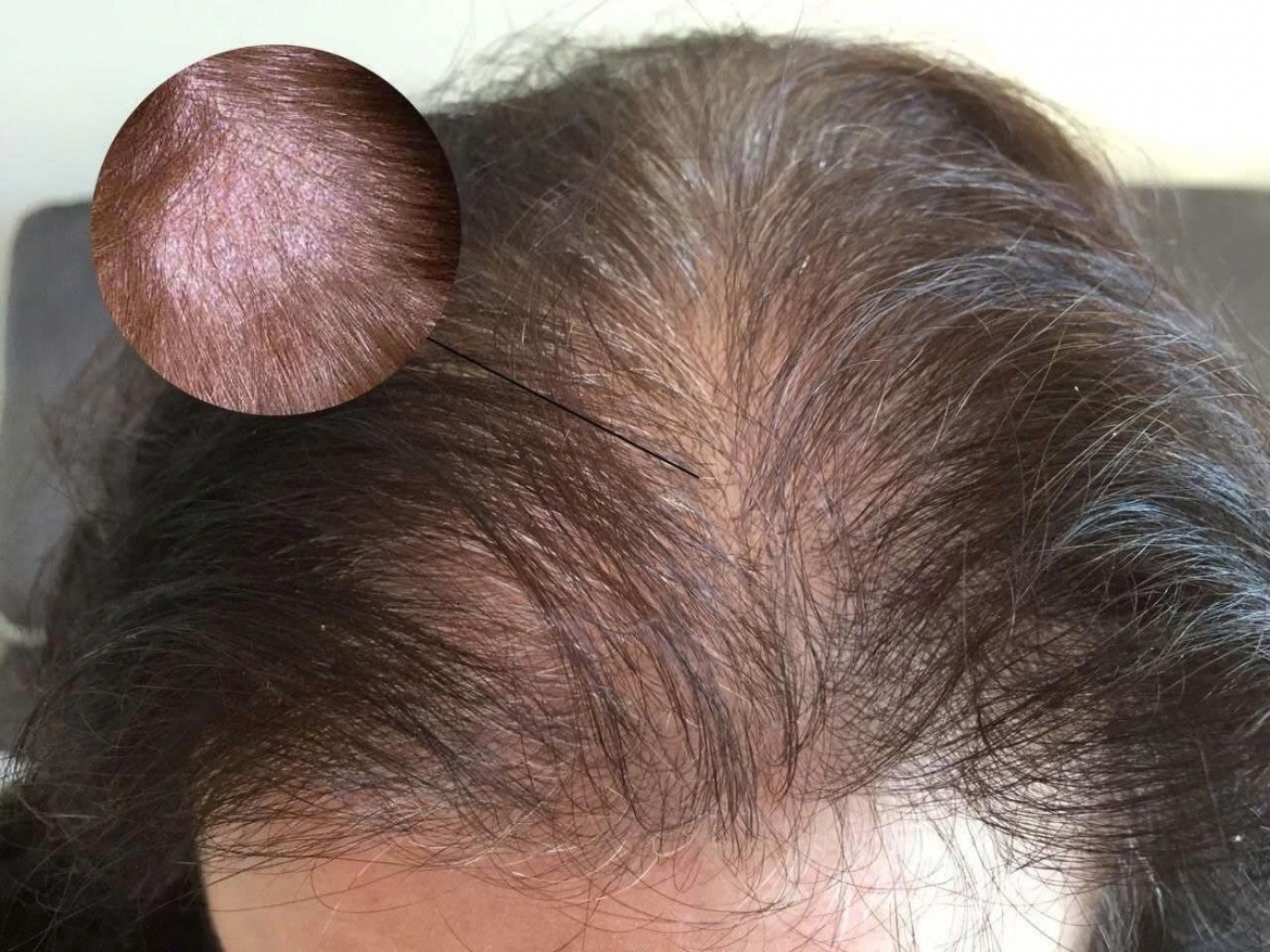 Chăm sóc da đầu yếu đúng cách giúp cải thiện tình trạng tóc gãy rụng, da đầu khô - nhờn bất thường, ngứa hoặc nhạy cảm