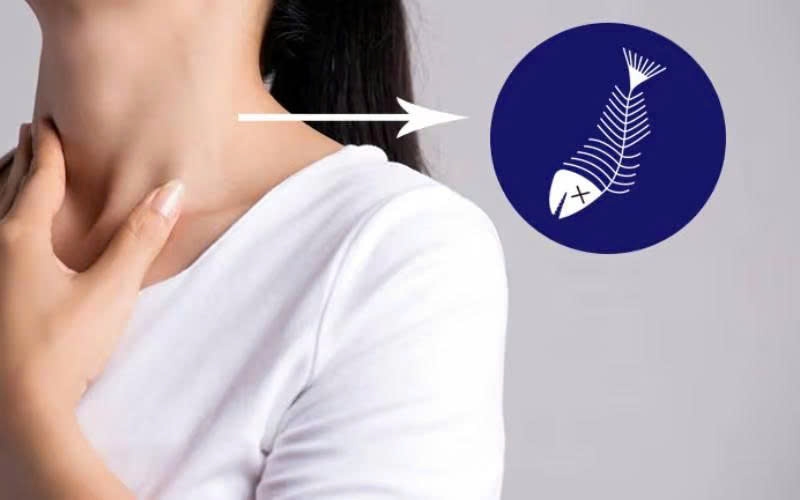 Hóc xương cá là tình huống thường gặp nhưng không nên chủ quan