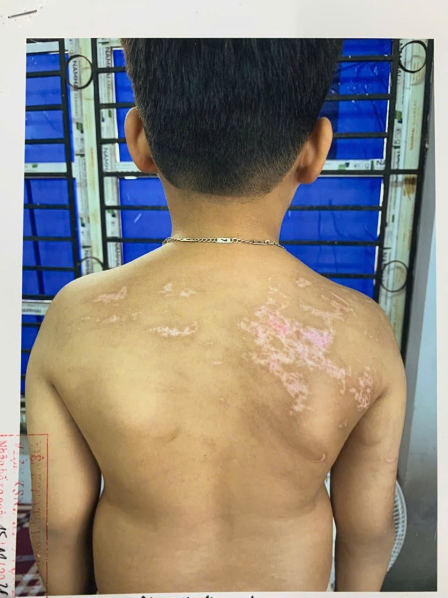 Hình ảnh thương tích của cháu N. Đ. B. K. sau khi bị Nguyễn Hà Chung đánh gây thương tích.