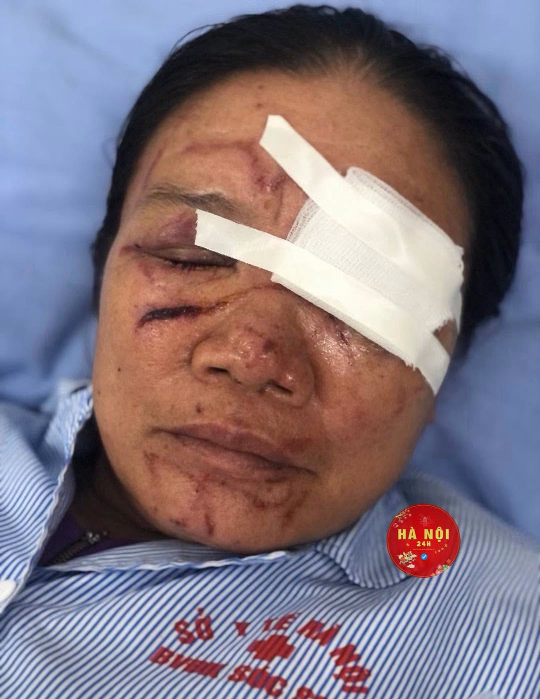 Sau khi được thăm khám và điều trị, sức khỏe bệnh nhân ổn định, hiện đang điều trị tại Bệnh viện Đa khoa Sóc Sơn.