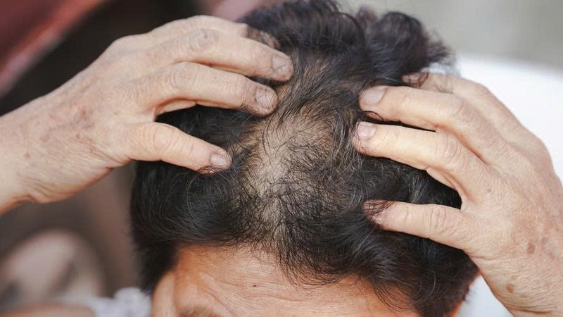 Rụng tóc khá phổ biến ở phụ nữ trung niên do thay đổi nội tiết, lão hóa và áp lực cuộc sống