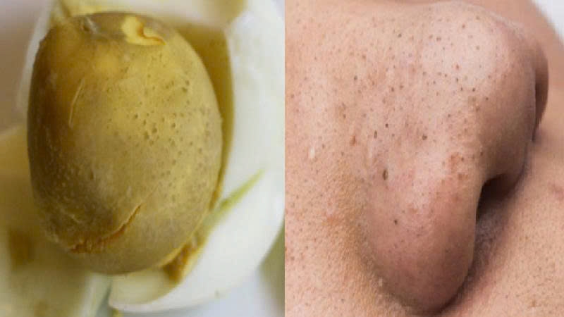 Lăn trứng gà hút mụn là mẹo dân gian được nhiều người áp dụng