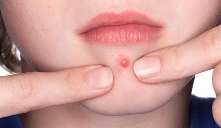 Để hạn chế sưng đỏ sau khi nặn mụn, chỉ nên lấy nhân khi mụn đã chín, đồng thời rửa tay và sát khuẩn dụng cụ trước khi thực hiện