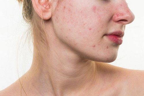 Tẩy tế bào chết đúng cách giúp da mụn loại bỏ tế bào sừng, thông thoáng lỗ chân lông và hỗ trợ cải thiện tình trạng mụn